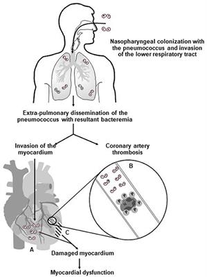 Platelets and Their Role in the Pathogenesis of Cardiovascular Events in Patients With Community-Acquired Pneumonia